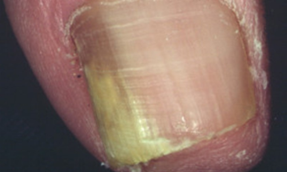 fungal nail infection